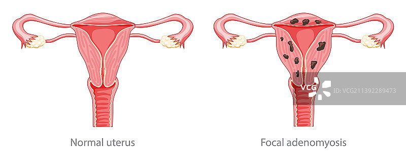 子宫腺肌症病灶人体女性解剖图片素材