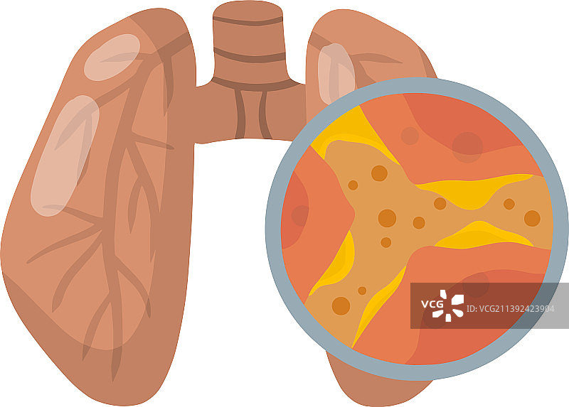 肺部疾病的运河堵塞图片素材
