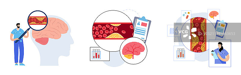 脑卒中缺血图片素材