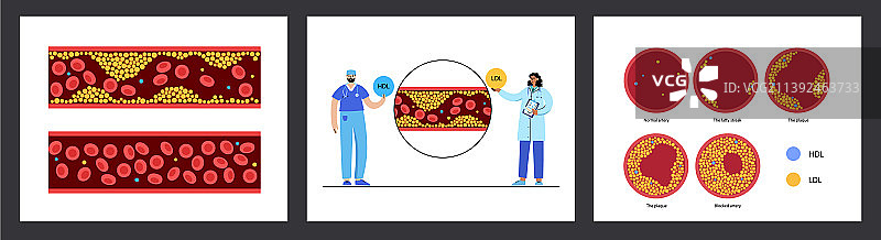 胆固醇与血管图片素材