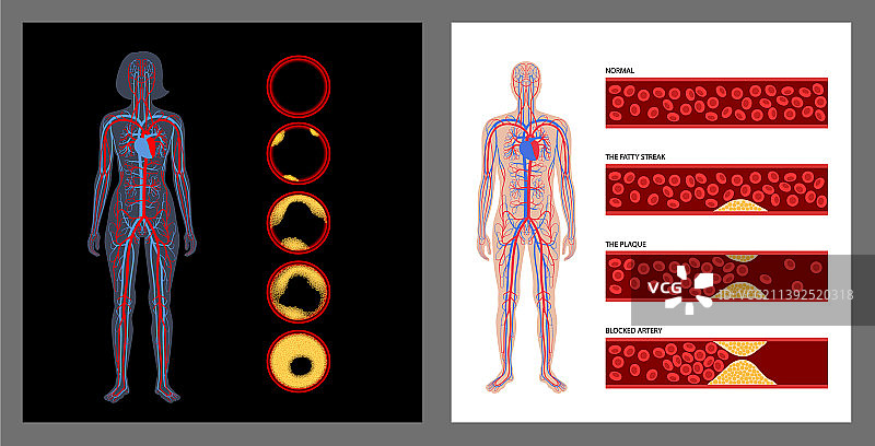 胆固醇与动脉粥样硬化图片素材