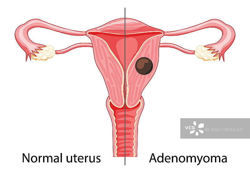 子宫腺肌症人体解剖女性图片素材