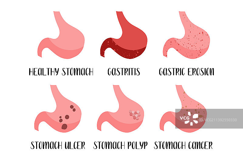 胃部疾病：胃炎和胃糜烂图片素材