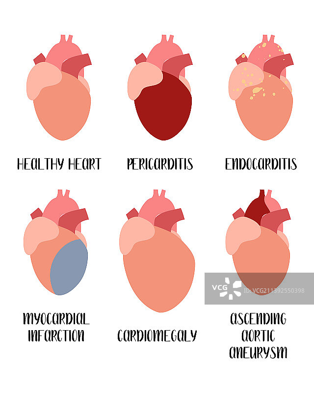 心血管疾病心包炎图片素材