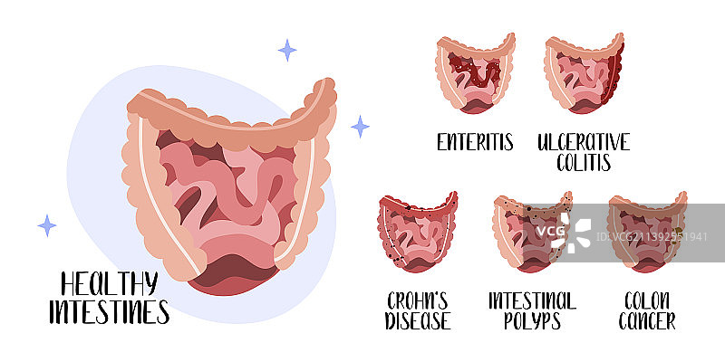 肠道疾病：肠炎溃疡图片素材
