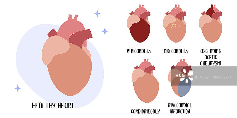 心血管疾病心包炎图片素材