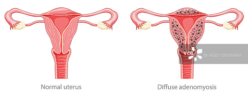 弥漫性子宫腺肌症人体解剖女性疾病图片素材