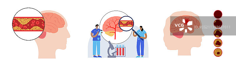 脑卒中缺血图片素材