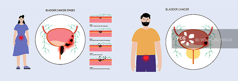 膀胱癌分期图片素材