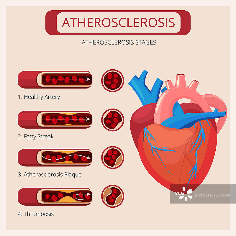 动脉粥样硬化阶段：心脏中风血栓图片素材