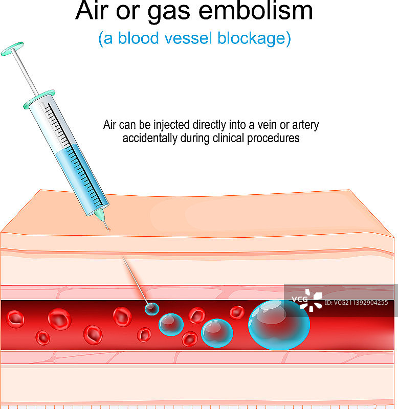 空气或气体栓塞血管堵塞图片素材