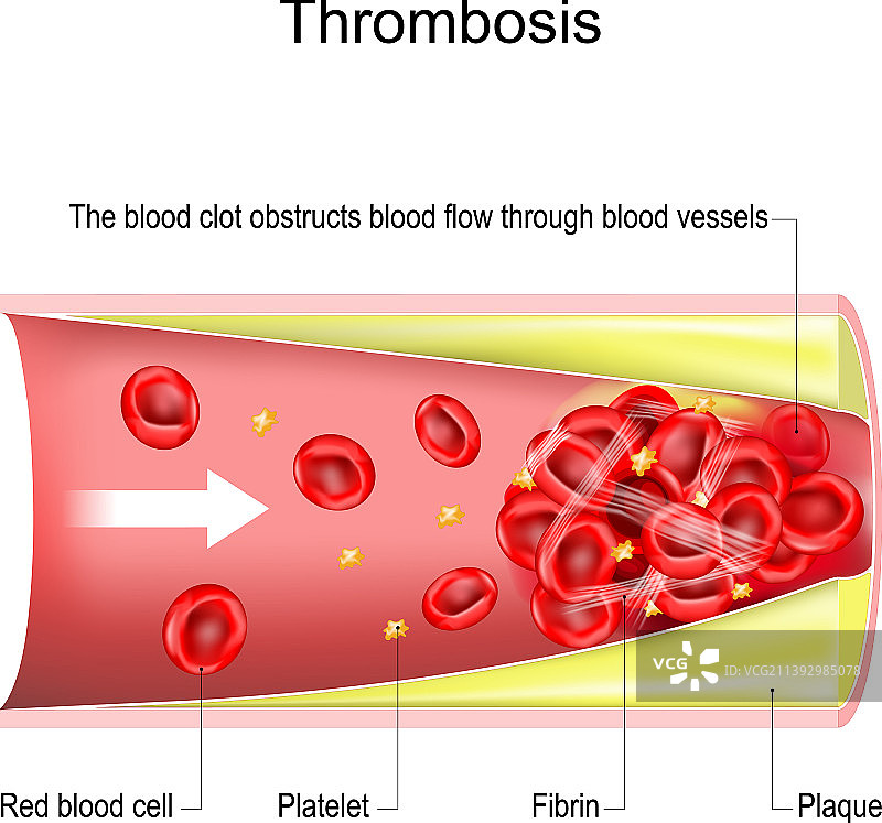 血栓阻塞血流图片素材