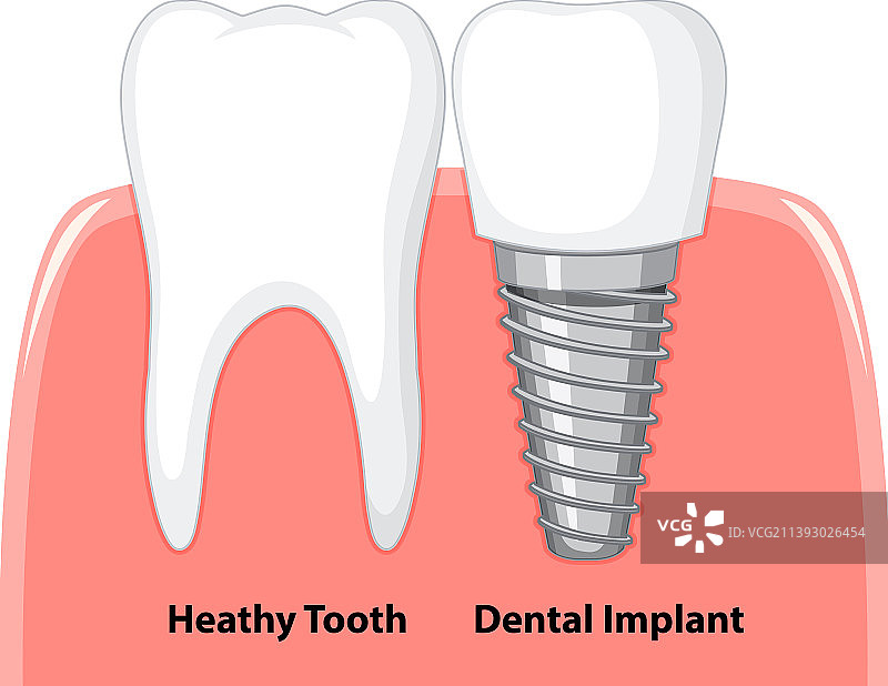 健康的牙齿和牙科植入体图片素材