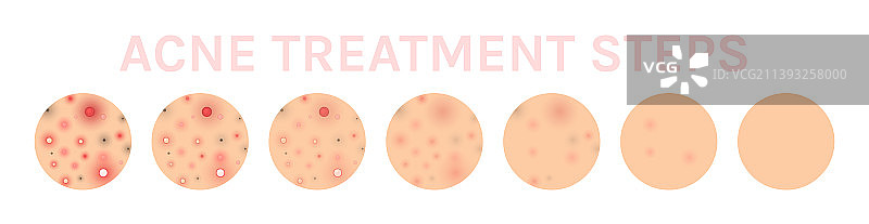 带粉刺的问题皮肤图标及皮肤护理图片素材