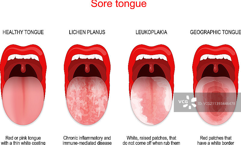 健康与白色舌头对比图片素材