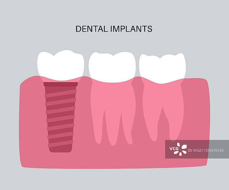 牙科植入程序图片素材