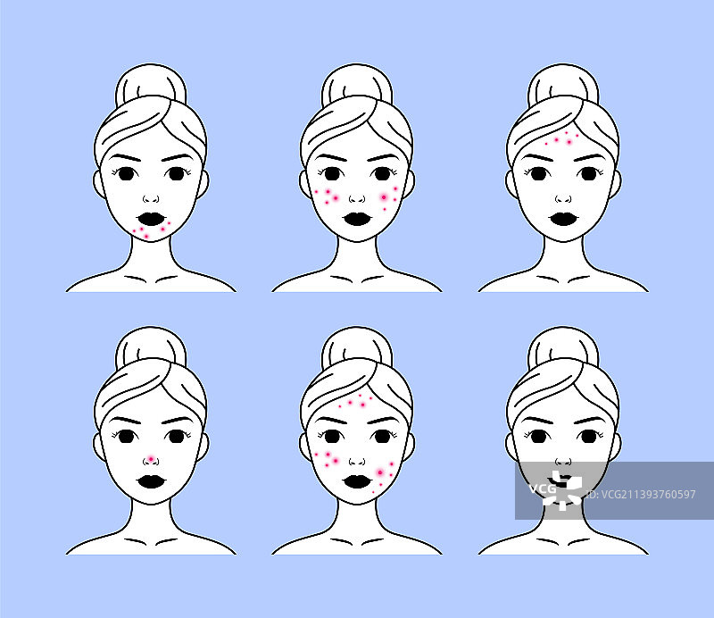 下巴、脸颊和额头长粉刺的女人图片素材