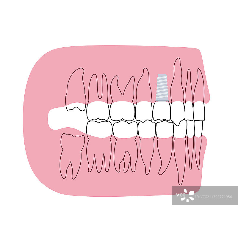 牙科植入程序图片素材