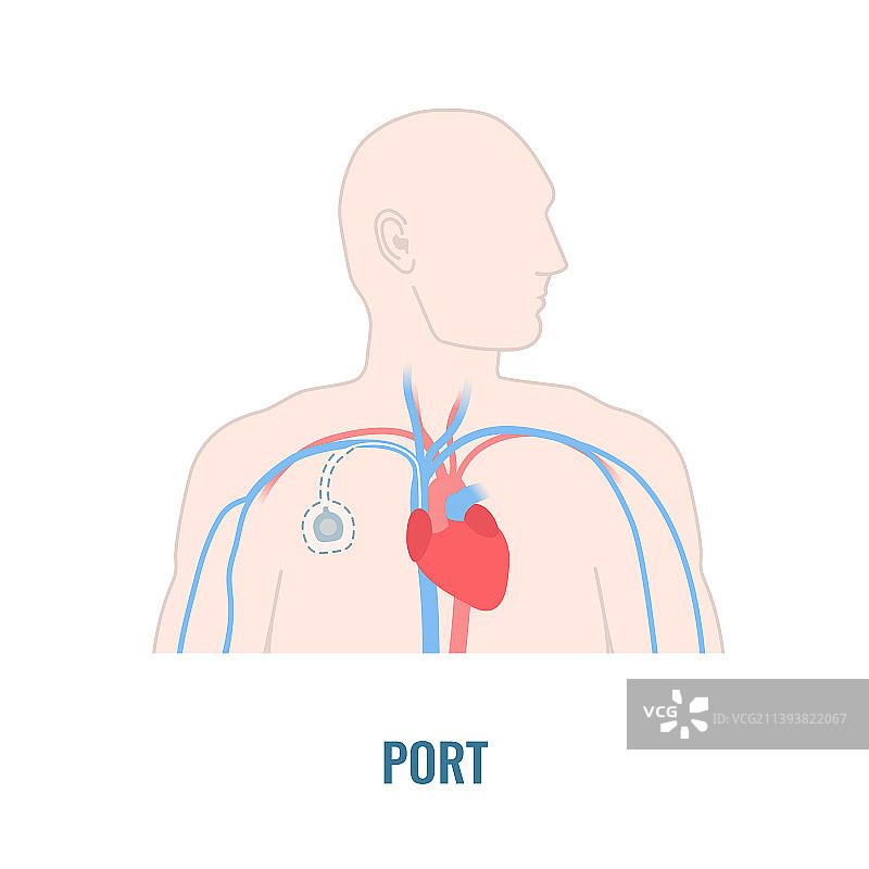 男性身体上的植入式静脉通路端口图片素材