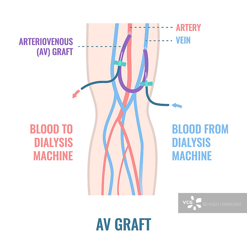 手臂上的动静脉透析分流移植导管图片素材