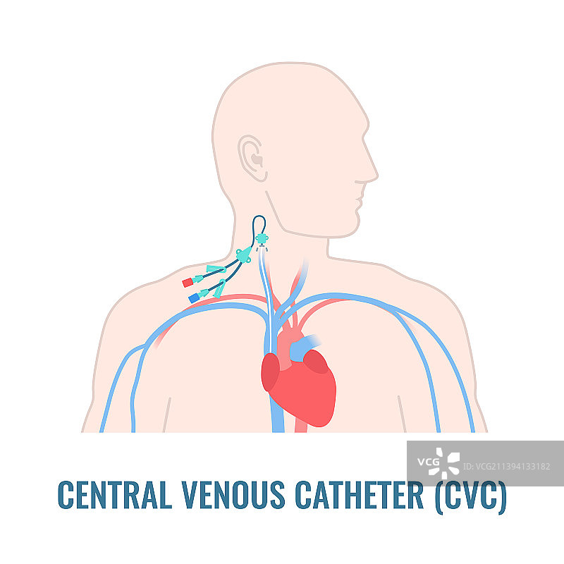 颈内静脉中心静脉导管特写图片素材
