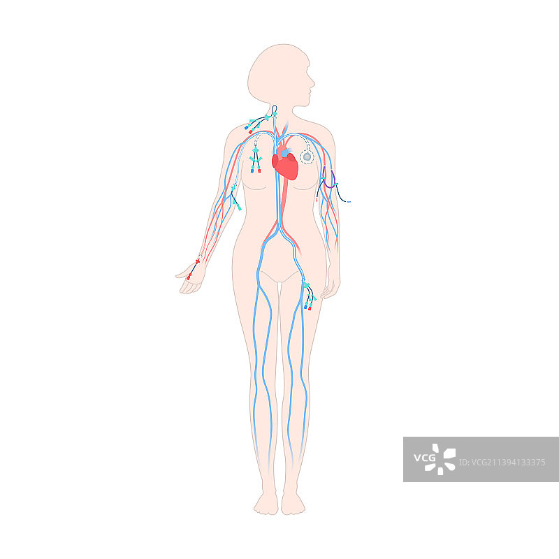 女性身体上的中心静脉导管类型图片素材