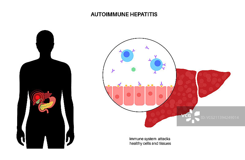 自身免疫性肝炎图片素材