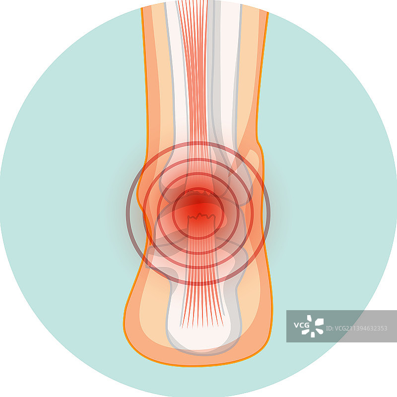 跟腱断裂圆形模板图片素材
