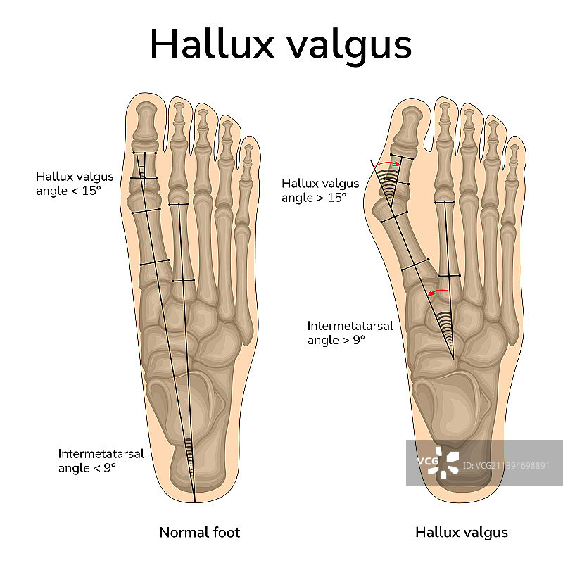 拇外翻图片素材