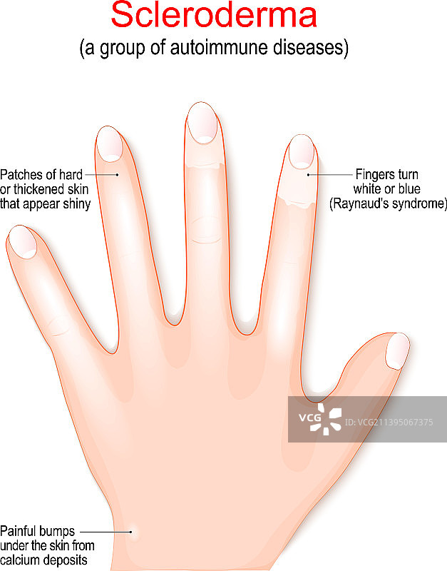 硬皮病自身免疫疾病的体征和症状图片素材