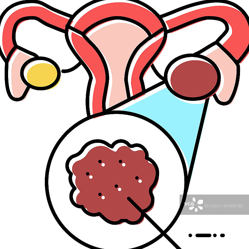 多囊卵巢综合征内分泌学彩色图标图片素材