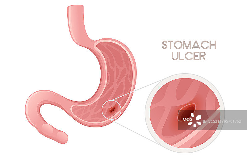 人体胃溃疡卡通设计图片素材