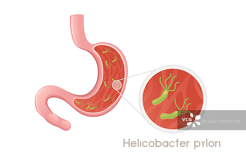 幽门螺杆菌与人类胃部卡通图片素材