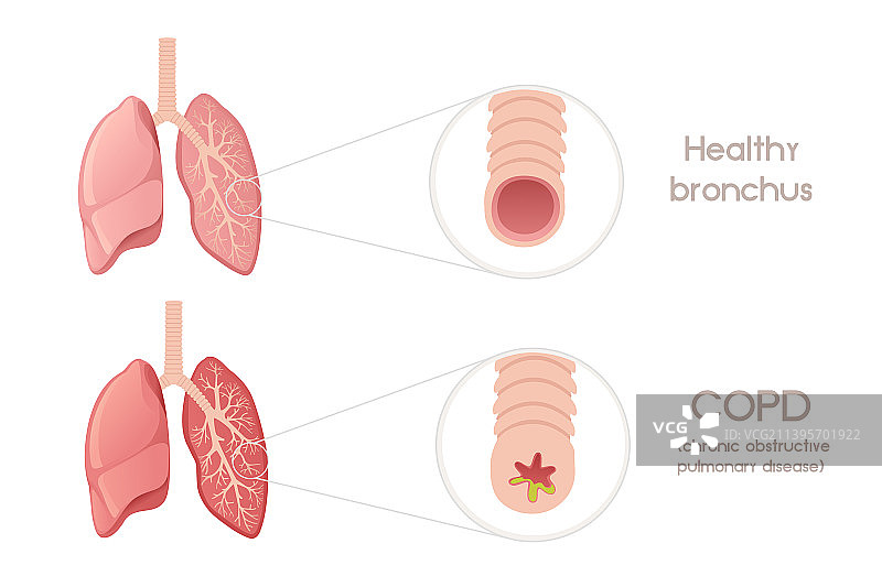 支气管炎卡通肺部设计图片素材