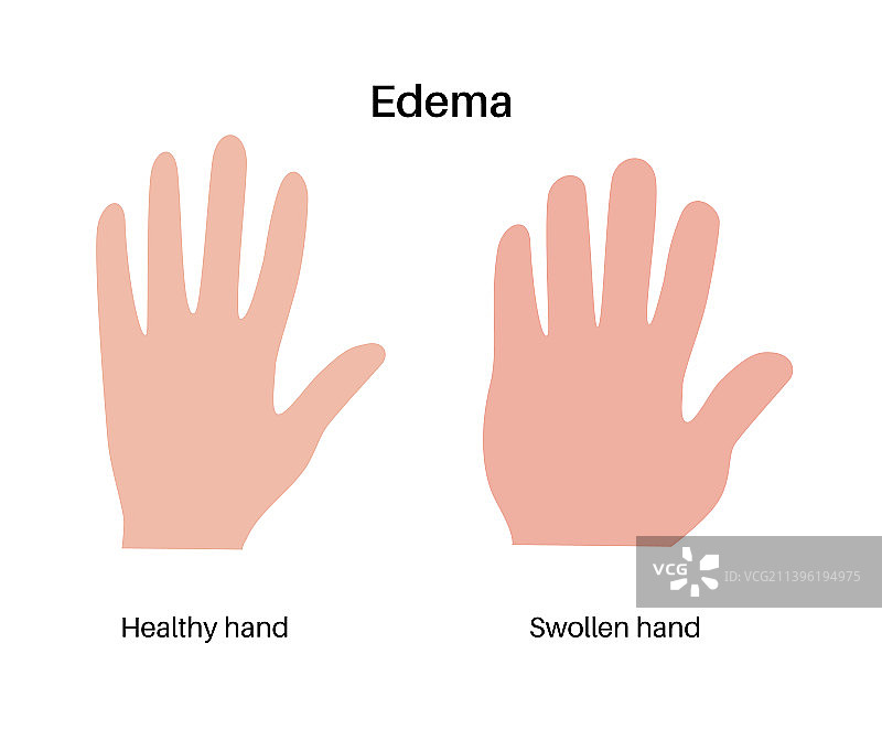 手臂水肿图片素材