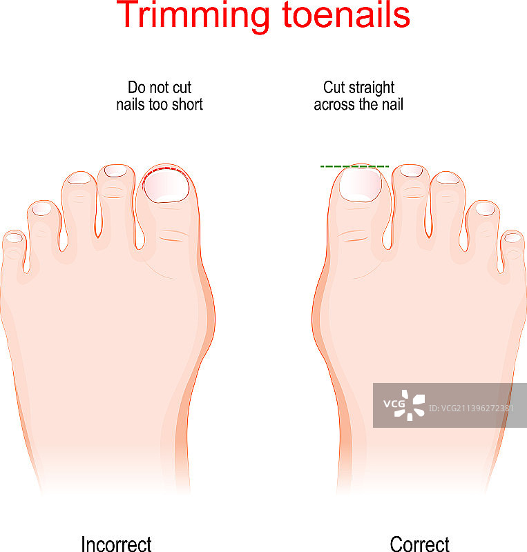 修剪脚趾甲的正确与错误示范图片素材