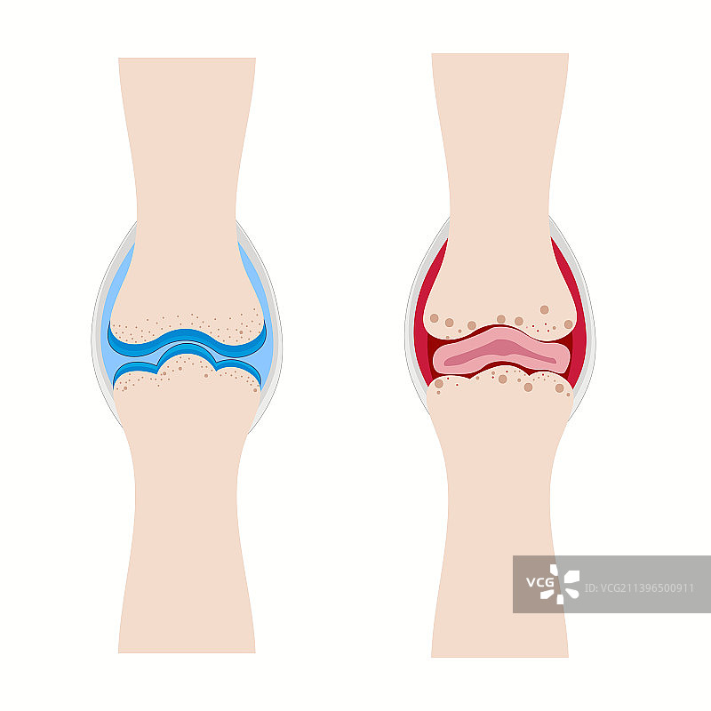 正常关节与类风湿性关节炎图片素材
