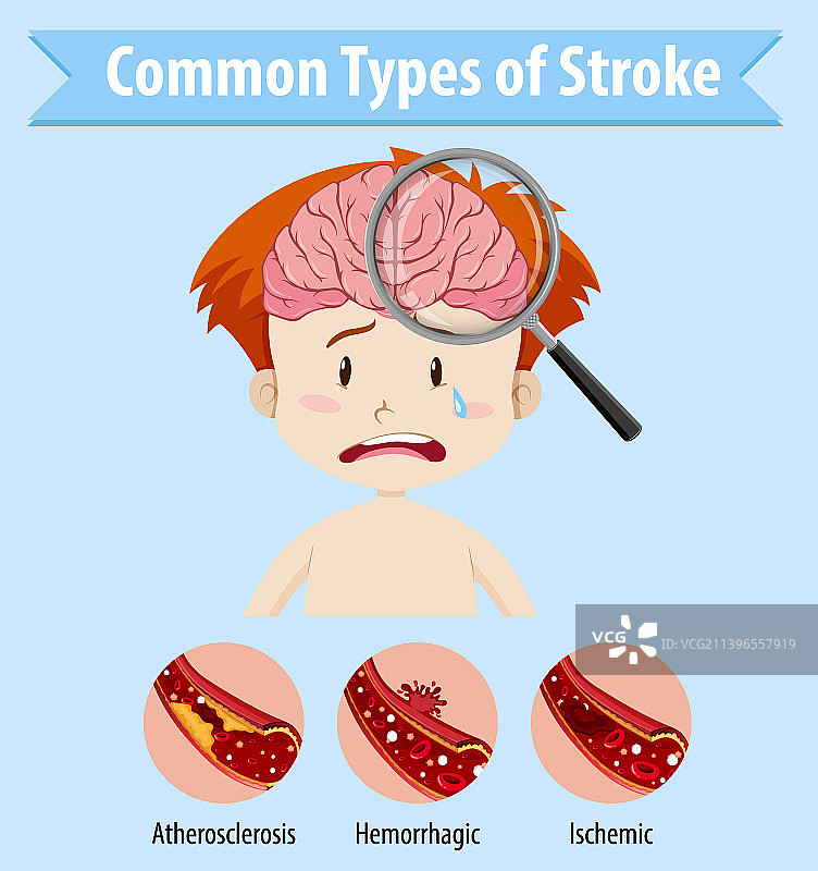 常见中风类型图片素材