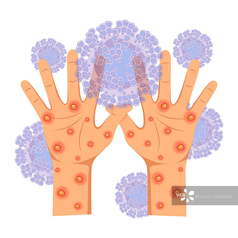 患有脓性溃疡皮疹的双手图片素材