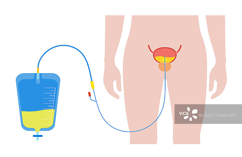 尿液引流袋图片素材