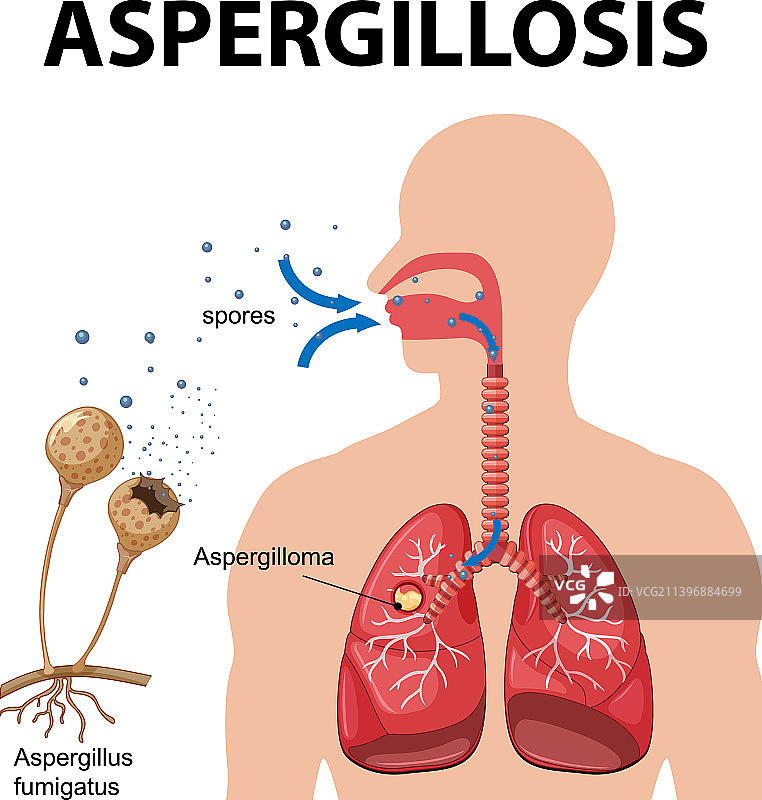 显示曲霉菌感染的图图片素材