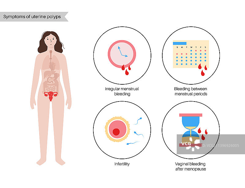子宫息肉疾病图片素材