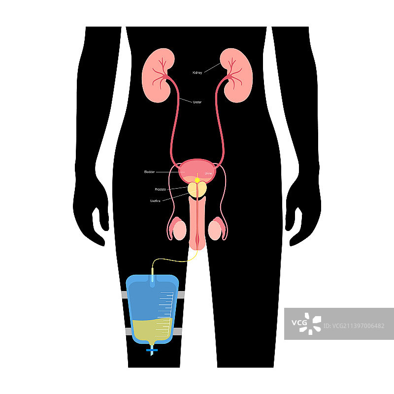 尿液引流袋图片素材