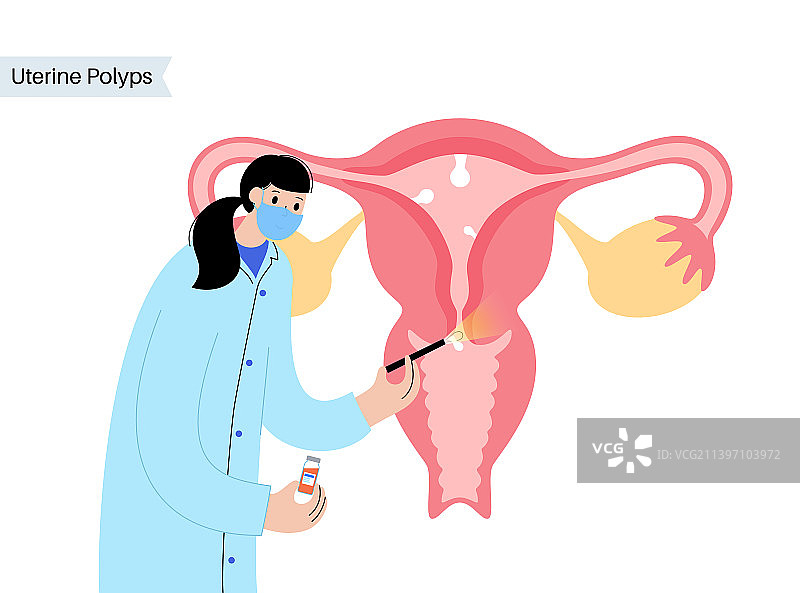 子宫息肉疾病图片素材