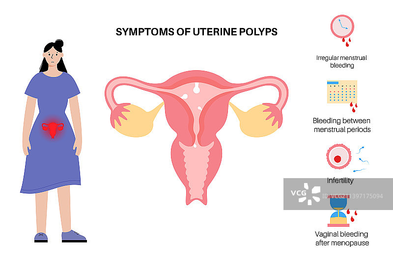 子宫息肉疾病图片素材