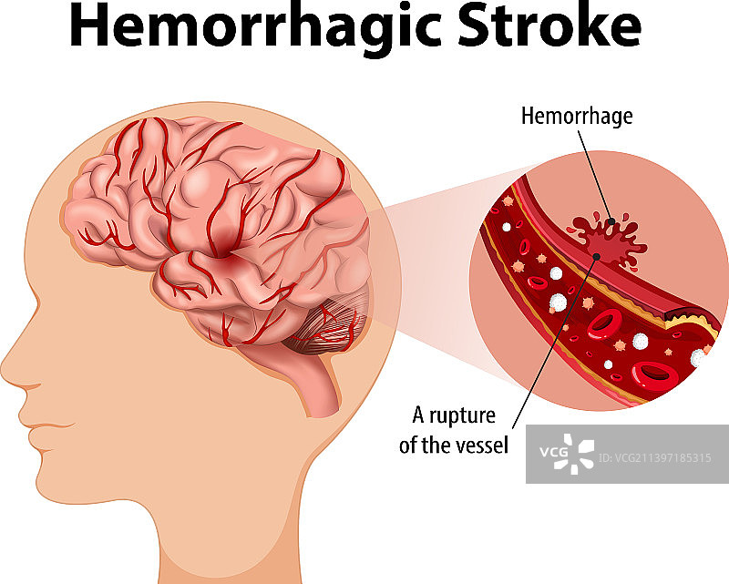 患出血性中风的病人图片素材