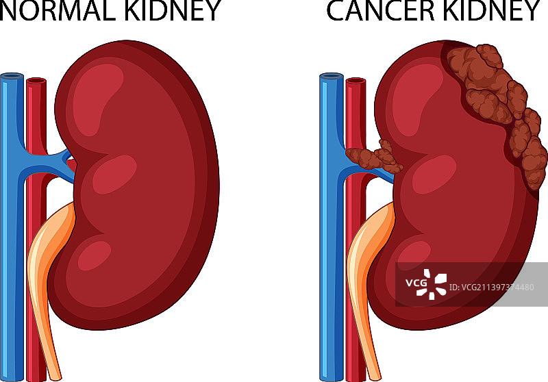 正常肾脏和癌变肾脏图片素材