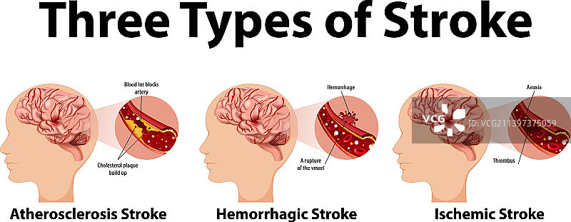 常见中风类型信息图图片素材