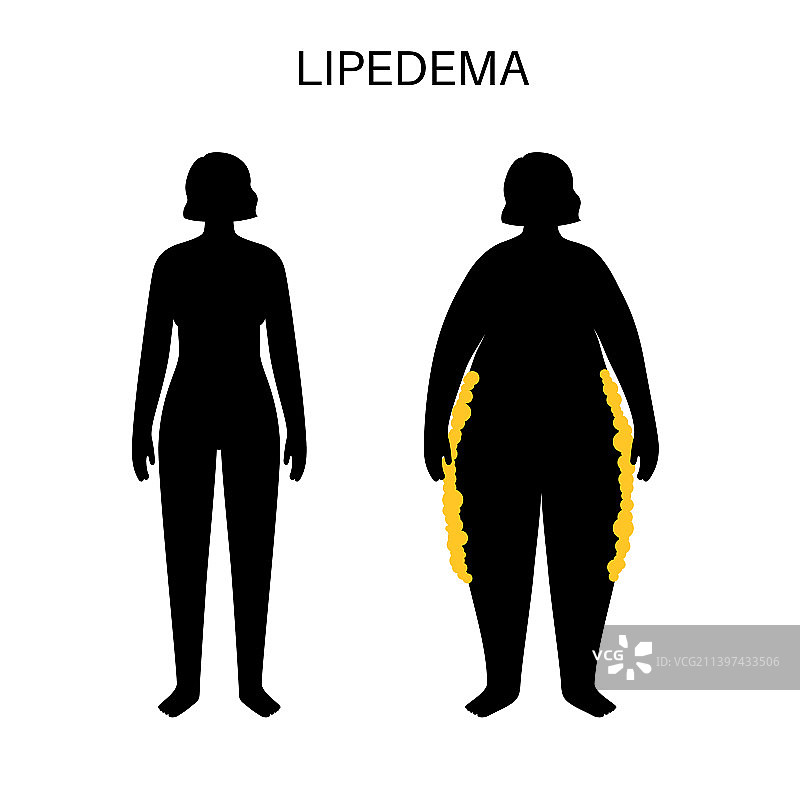 淋巴水肿脂肪区域图片素材