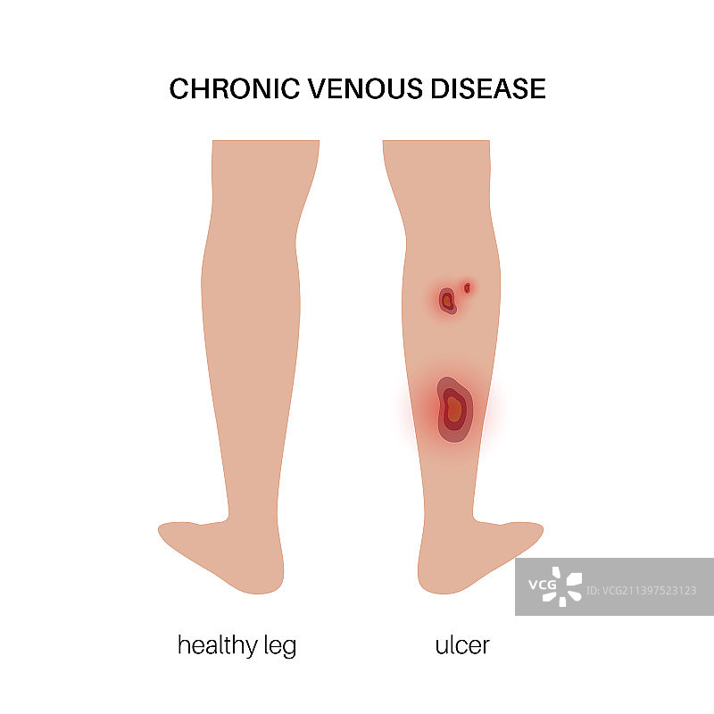 营养性溃疡解剖图片素材